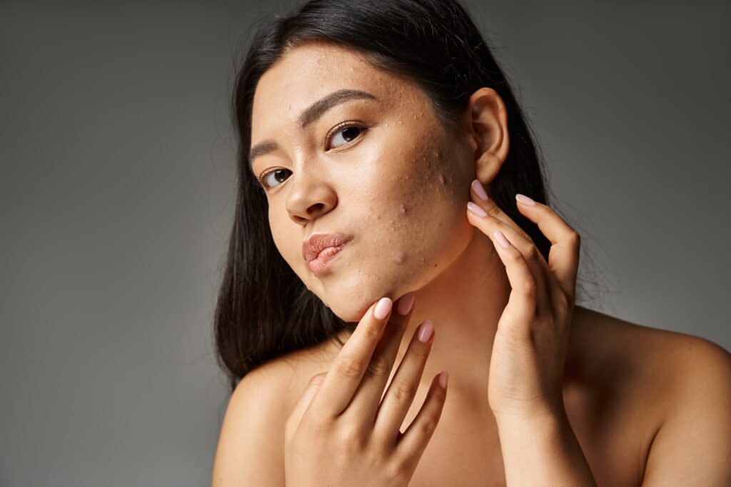 Can Nutrition Help With Hormonal Acne?